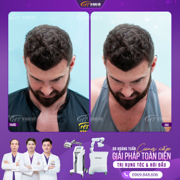 Dịch vụ cấy tóc trị hói: Phương pháp khoa học phục hồi mái tóc hói